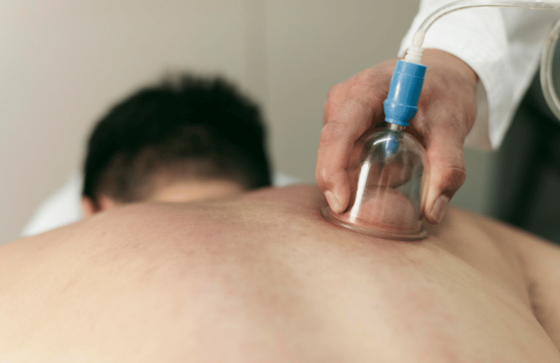 Sports Cupping Therapy Boca Raton | Relieve Muscle Tension