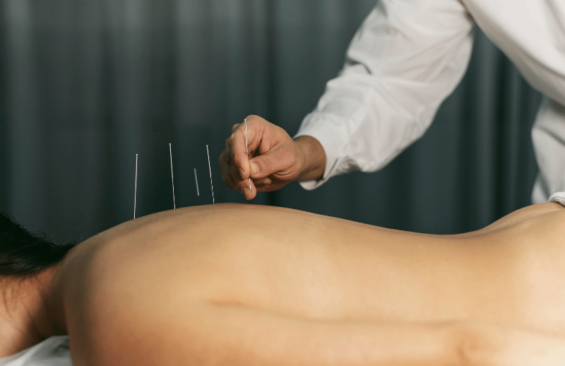 Sports Recovery and Muscle Release with Dry Needling in Boca Raton